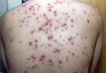 Com 11 casos de catapora, escola de Cruzeiro do Sul suspende aulas