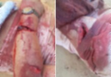 Em Mâncio Lima, homem quase perde o braço após levar terçadas em discussão