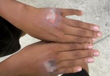 Mãe queima filho com chapinha de cabelo: “Comeu iogurte sem permissão”