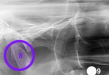 Moradora de Cruzeiro do Sul convive há mais de dez anos com dor após fragmento de agulha ficar preso na mandíbula