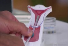 Acre passa a oferecer DIU e Implanon gratuitos para jovens de 14 a 19 anos