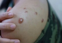 Caso suspeito de mpox é descartado e Rio Branco não tem registro confirmado da doença