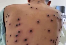 Mpox: Porto Velho registra primeiro caso confirmado de varíola dos macacos