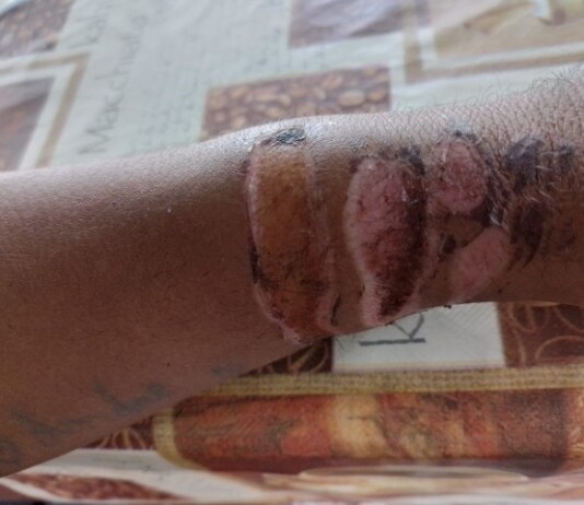 Manciolimense sofre hematomas após ser hospitalizado no Hospital do Juruá