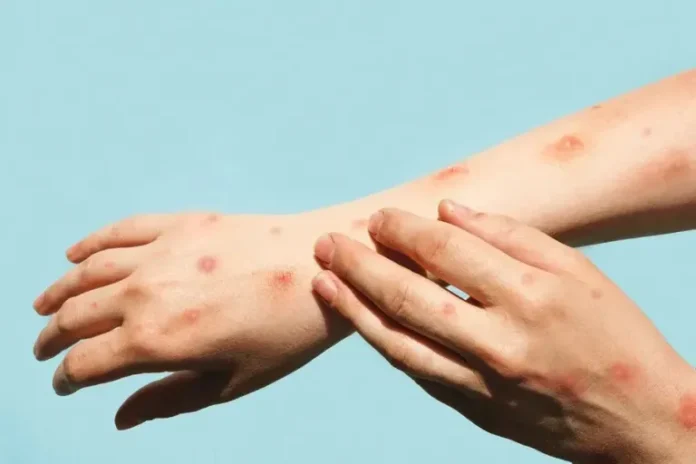 pessoa-com-mpox-getty-images