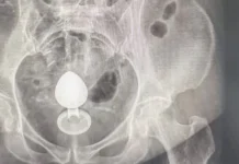 Mulher é internada após plug anal ficar preso no intestino; médicos alertam para riscos no uso do acessório