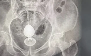 Mulher é internada após plug anal ficar preso no intestino; médicos alertam para riscos no uso do acessório